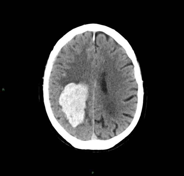 File:Cerebral amyloid angiopathy-associated lobar intracerebral hemorrhage (Radiopaedia 59356-66716 Axial non-contrast 17).jpg