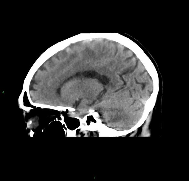 File:Cerebral amyloid angiopathy-associated lobar intracerebral hemorrhage (Radiopaedia 59356-66716 C 34).jpg