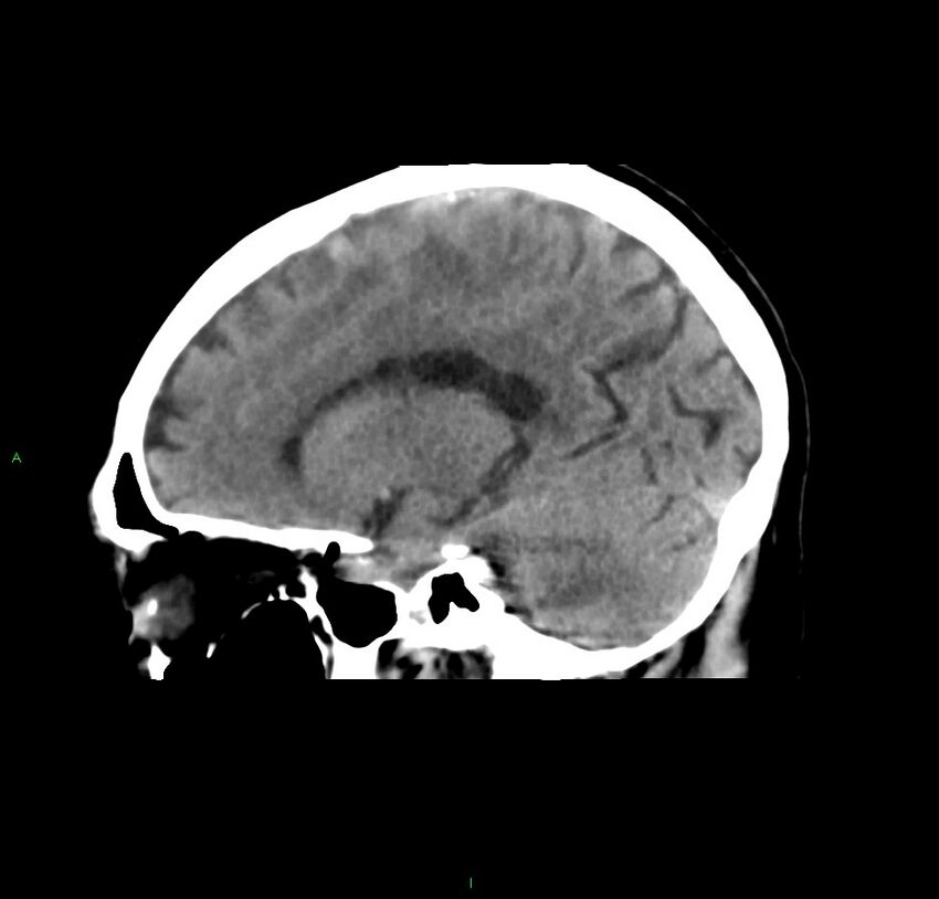 Cerebral amyloid angiopathy-associated lobar intracerebral hemorrhage (Radiopaedia 59356-66716 C 34).jpg