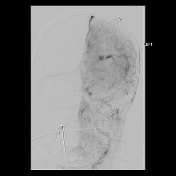 File:Cerebral arteriovenous malformation with lobar hemorrhage (Radiopaedia 44725-48513 LT CCA IC 16).png