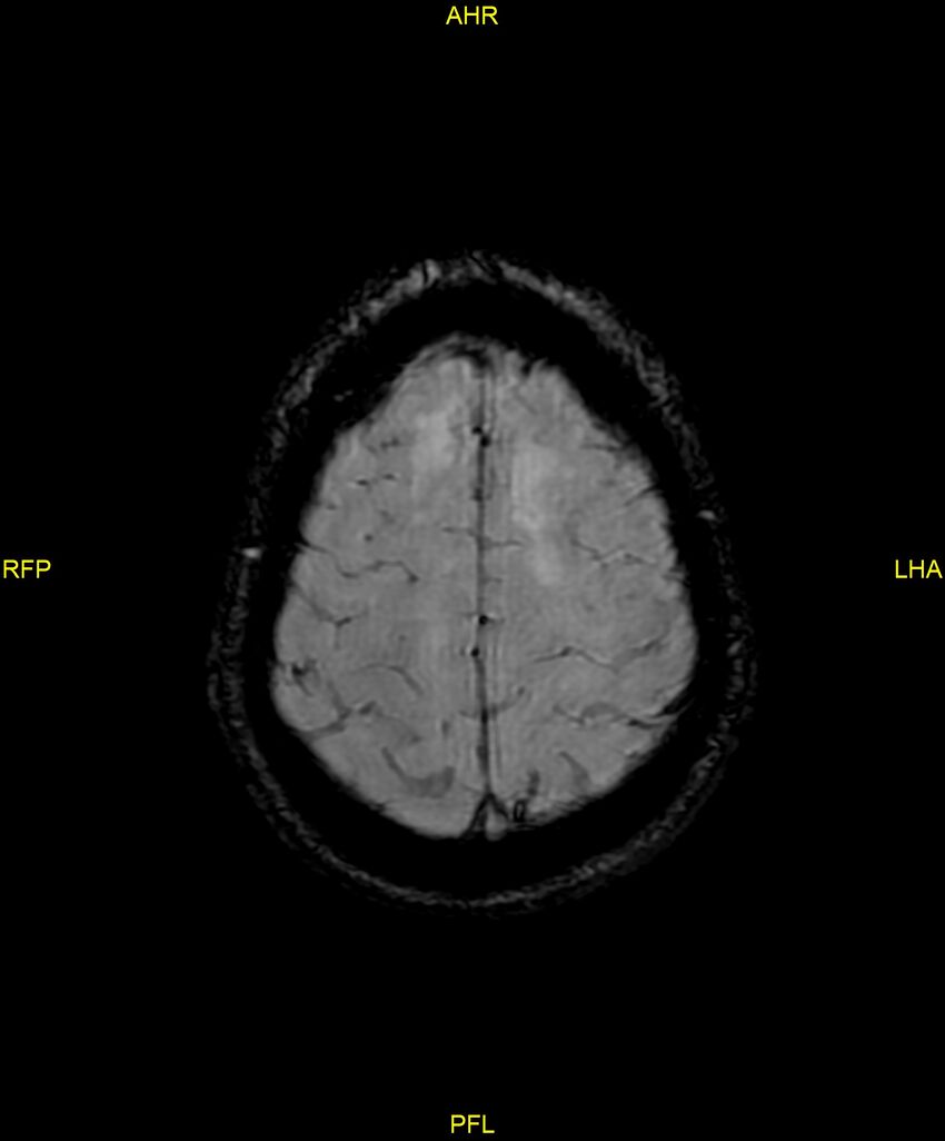 Cerebral autosomal dominant arteriopathy with subcortical infarcts and leukoencephalopathy (CADASIL) (Radiopaedia 86108-102054 Axial SWI 90).jpg