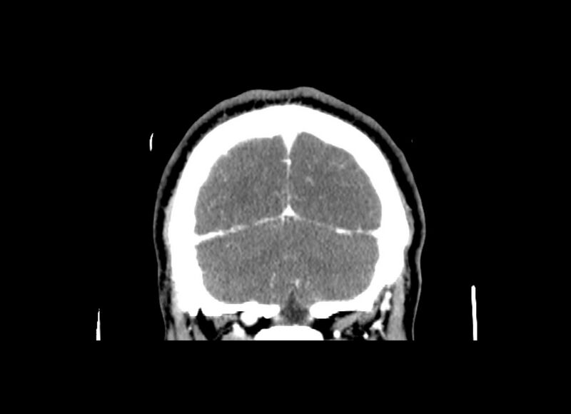 File:Cerebral edema (Radiopaedia 82519-96661 C 14).jpg