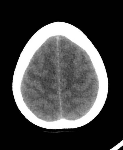 File:Cerebral edema due to severe hyponatremia (Radiopaedia 89826-106937 Axial non-contrast 77).jpg