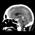Cerebral hemorrhagic contusions (Radiopaedia 23145-23188 C 23).jpg