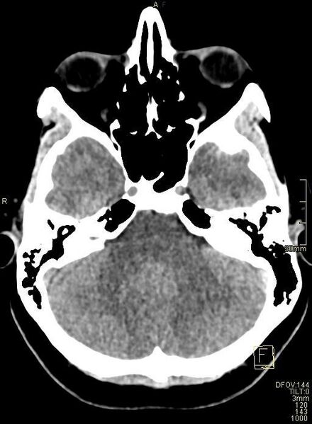 File:Cerebral venous sinus thrombosis (Radiopaedia 91329-108965 Axial non-contrast 13).jpg