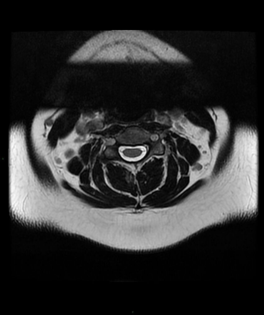 Cervical disc prolapse (Radiopaedia 80258-93598 Axial T2 14).jpg