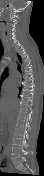 File:Cervical dural CSF leak on MRI and CT treated by blood patch (Radiopaedia 49748-54996 A 15).png