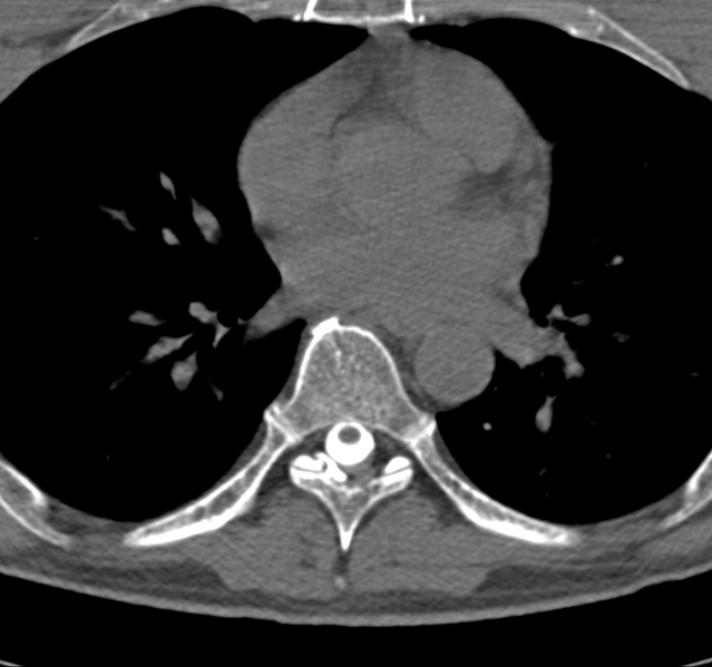 File:Cervical dural CSF leak on MRI and CT treated by blood patch (Radiopaedia 49748-54996 B 62).png