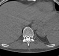 Cervical dural CSF leak on MRI and CT treated by blood patch (Radiopaedia 49748-54996 B 75).png