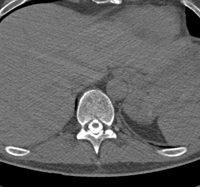 File:Cervical dural CSF leak on MRI and CT treated by blood patch (Radiopaedia 49748-54996 B 75).png