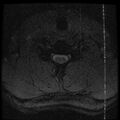 Cervical flexion teardrop fracture with cord hemorrhage (Radiopaedia 32497-33455 Axial Gradient Echo 21).jpg