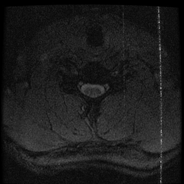 File:Cervical flexion teardrop fracture with cord hemorrhage (Radiopaedia 32497-33455 Axial Gradient Echo 21).jpg