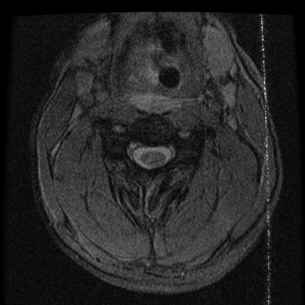 File:Cervical flexion teardrop fracture with cord hemorrhage (Radiopaedia 32497-33455 Axial Gradient Echo 9).jpg