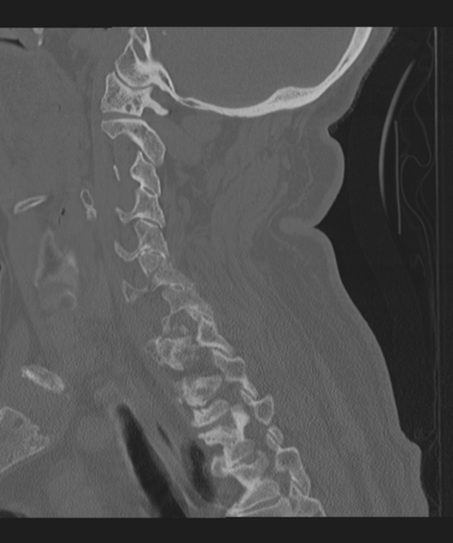 File:Cervical spine fracture in the setting of ankylosis (Radiopaedia 37038-38715 Sagittal bone window 52).png