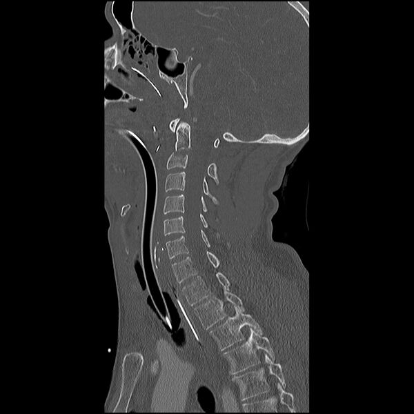 File:Cervical spine fractures with vertebral artery dissection (Radiopaedia 32135-33078 Sagittal bone window 21).jpg