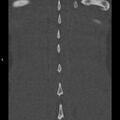 Chance fracture (Radiopaedia 36521-38081 Coronal bone window 61).jpg