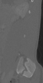 Chance fracture (Radiopaedia 40360-42912 Sagittal bone window 23).png