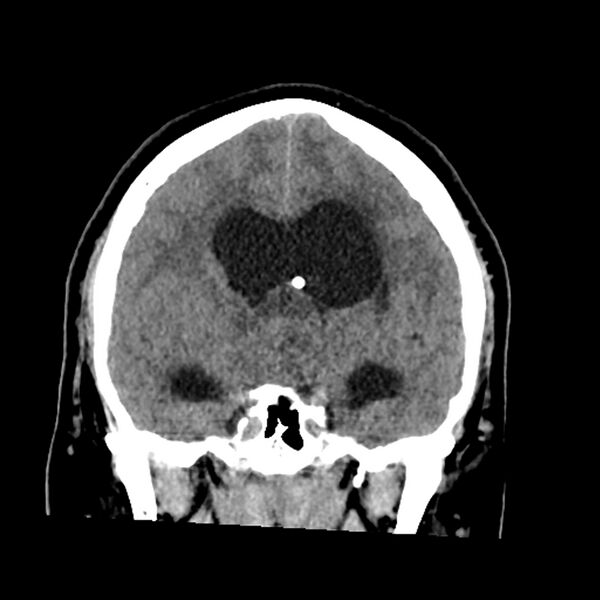 File:Chiasmatic-hypothalamic juvenile pilocytic astrocytoma (Radiopaedia 78533-91237 Coronal non-contrast 33).jpg