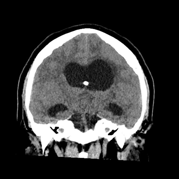 File:Chiasmatic-hypothalamic juvenile pilocytic astrocytoma (Radiopaedia 78533-91237 Coronal non-contrast 36).jpg