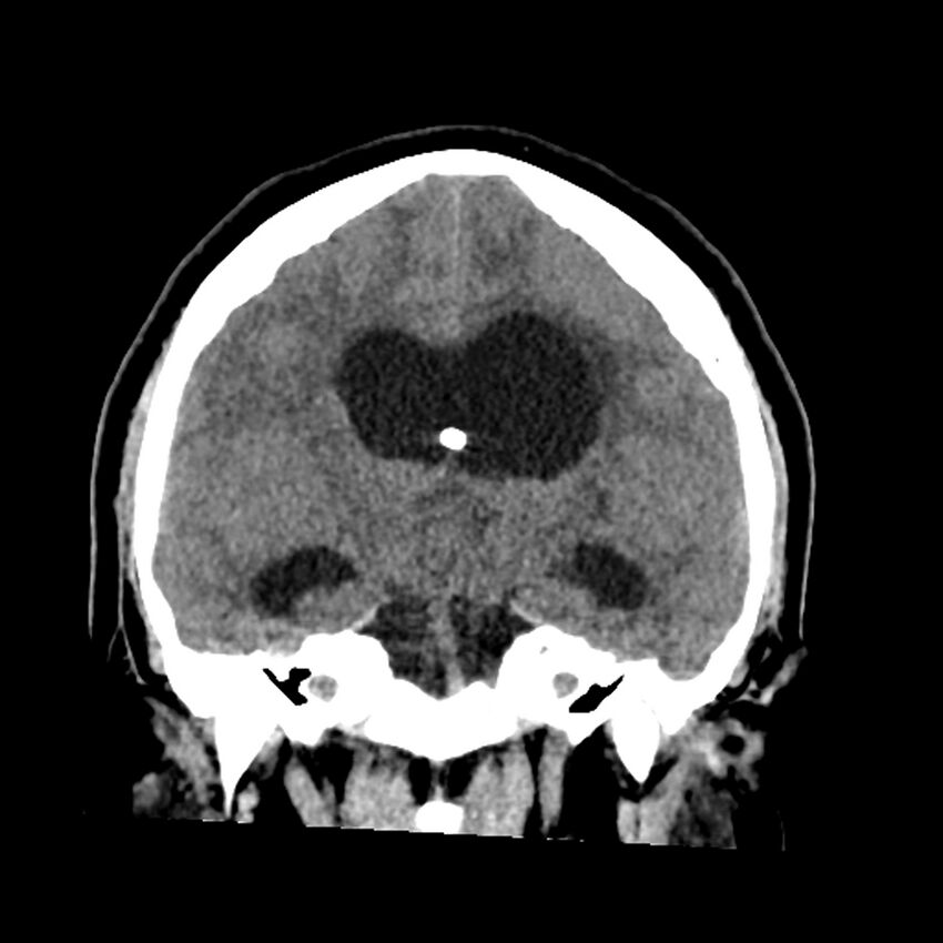 Chiasmatic-hypothalamic juvenile pilocytic astrocytoma (Radiopaedia 78533-91237 Coronal non-contrast 36).jpg
