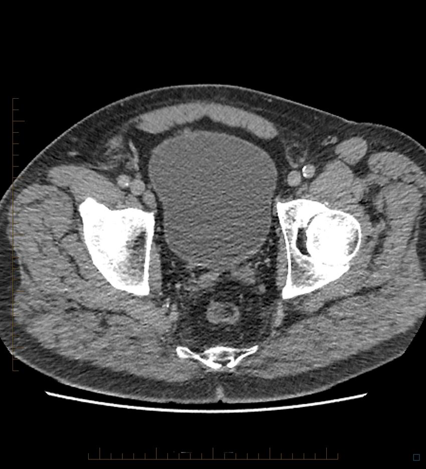Chicken bone in anal canal (Radiopaedia 51490-57253 Axial non-contrast 1).jpg