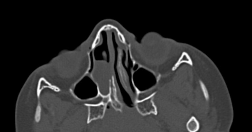 Choanal atresia (Radiopaedia 51295-56972 Axial bone window 30).jpg