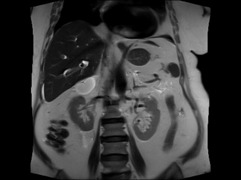 File:Choledocholithiasis causing intrahepatic biliary duct dilation (Radiopaedia 39908-42369 Coronal T2 15).jpg