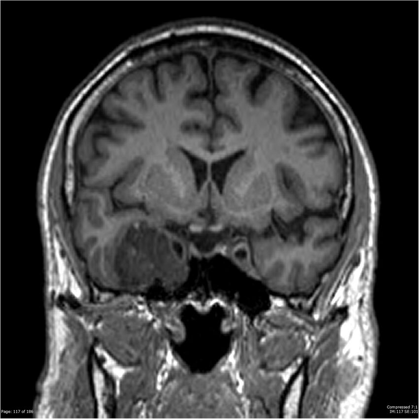 Chondrosarcoma of skull base- grade II (Radiopaedia 40948-43654 Coronal T1 38).jpg