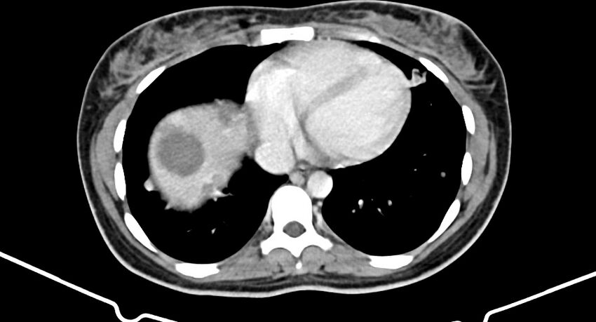 Choriocarcinoma liver metastases (Radiopaedia 74768-85766 A 17).jpg