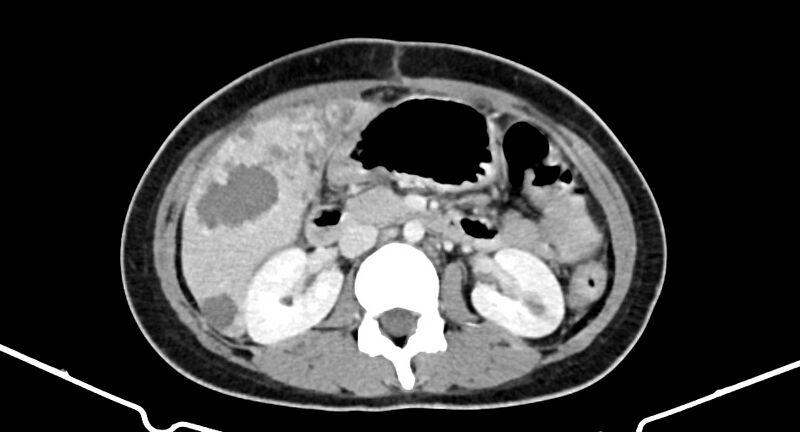 File:Choriocarcinoma liver metastases (Radiopaedia 74768-85766 A 96).jpg