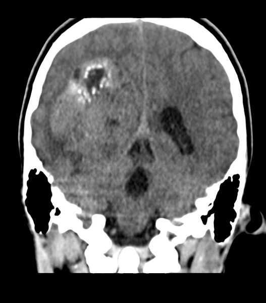 File:Choroid plexus carcinoma (Radiopaedia 91013-108552 Coronal non-contrast 57).jpg