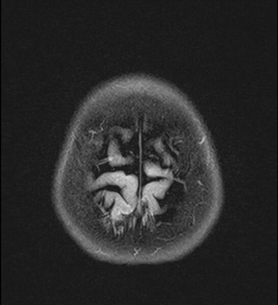 File:Choroid plexus xanthogranuloma (Radiopaedia 91271-108875 Axial T2 TIRM 25).jpg