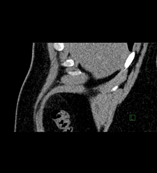 File:Chromophobe renal cell carcinoma (Radiopaedia 84286-99573 F 165).jpg