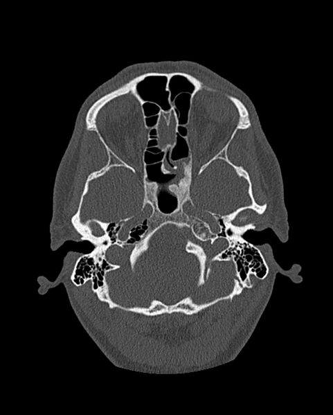 File:Chronic maxillary sinusitis caused by a foreign body (Radiopaedia 58521-65676 Axial bone window 224).jpg