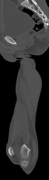 File:Chronic osteomyelitis (with sequestrum) (Radiopaedia 74813-85822 C 60).jpg