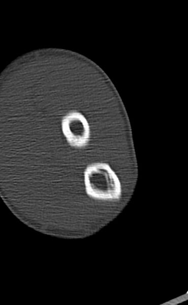 File:Chronic osteomyelitis of the distal humerus (Radiopaedia 78351-90971 Axial bone window 110).jpg