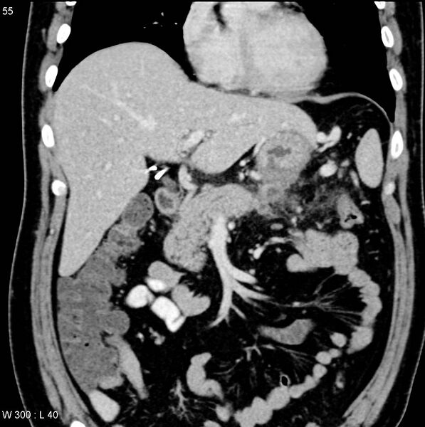 File:Chronic pancreatitis and pseudocysts (Radiopaedia 6724-7935 E 4).jpg