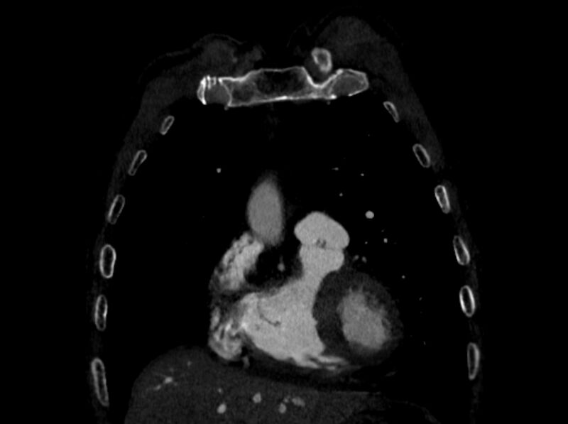 File:Chronic pulmonary embolism (Radiopaedia 91241-108843 A 18).jpg