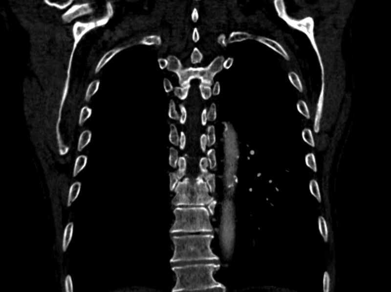 File:Chronic pulmonary embolism (Radiopaedia 91241-108843 A 91).jpg