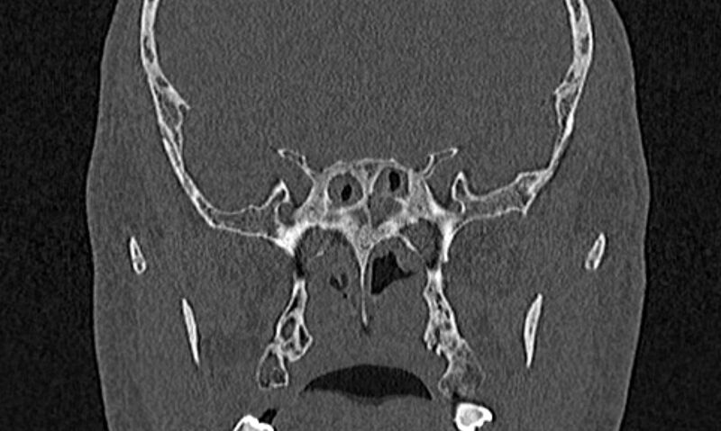 File:Chronic rhinosinusitis (Radiopaedia 65079-74075 Coronal bone window 63).jpg