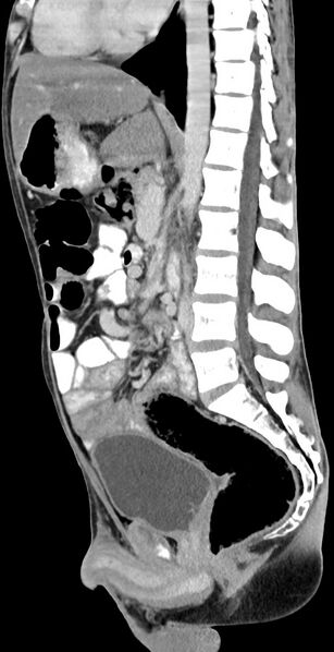 File:Chronic small bowel volvulus (Radiopaedia 75224-86322 C 74).jpg
