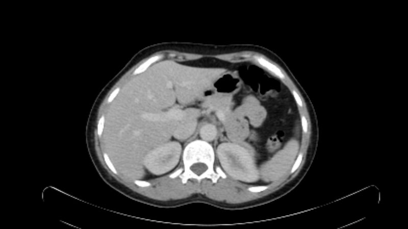 File:Circumaortic left renal vein (Radiopaedia 68147).jpg