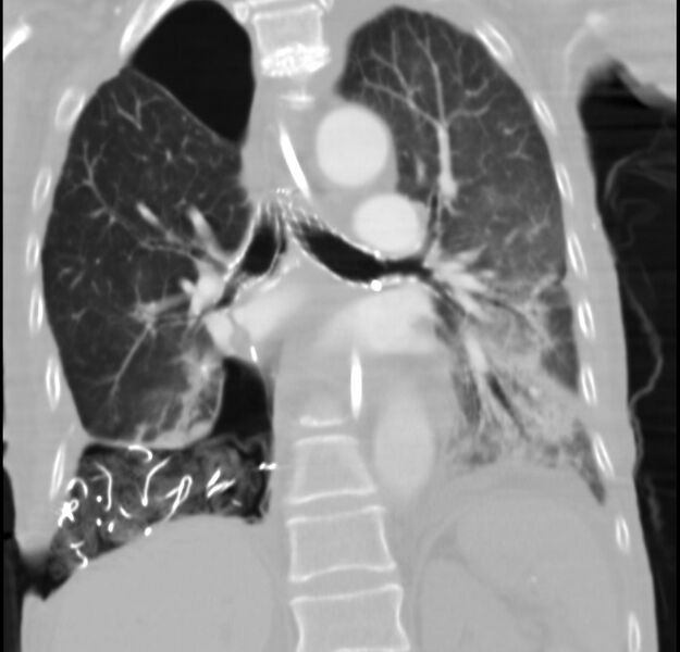 File:Clagett thoracotomy with bronchopleural fistula (Radiopaedia 29192-29587 Coronal lung window 13).jpg