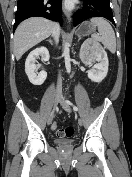 File:Clear cell renal cell carcinoma (Radiopaedia 61449-69393 F 24).jpg