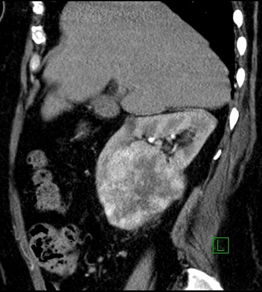 File:Clear cell renal cell carcinoma (Radiopaedia 85004-100537 D 44).jpg
