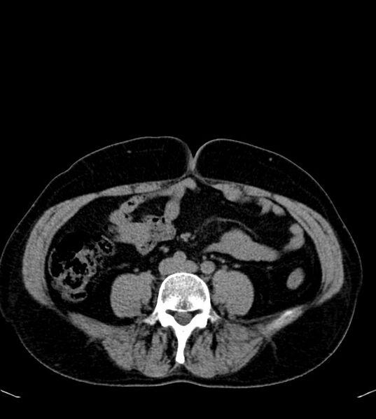 File:Clear cell renal cell carcinoma (Radiopaedia 85006-100539 Axial non-contrast 55).jpg
