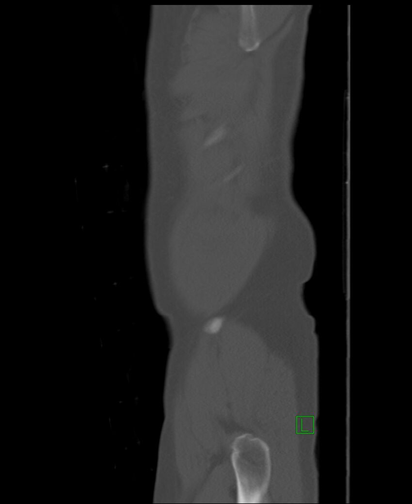 Clear cell renal cell carcinoma (Radiopaedia 85006-100539 Sagittal bone window 59).jpg