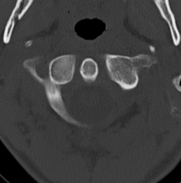 File:Cleft of the posterior arch of C1 mimicking fracture (Radiopaedia 40201-42721 Axial bone window 15).jpg