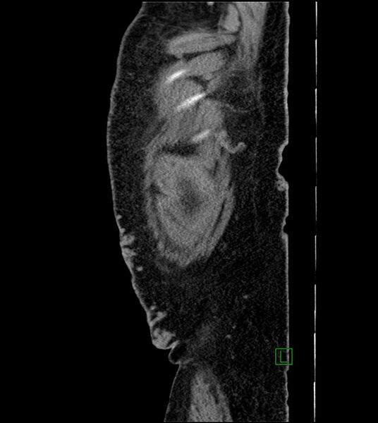 File:Closed-loop small bowel obstruction-internal hernia (Radiopaedia 78439-91096 C 16).jpg