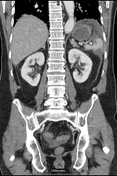 File:Closed loop bowel obstruction and ischemia (Radiopaedia 86959-103180 B 30).jpg